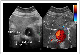 vascular dissecting aneurysm